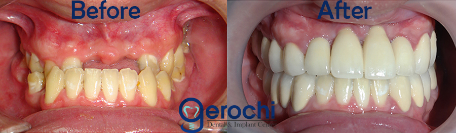 Before and After Dental Implant