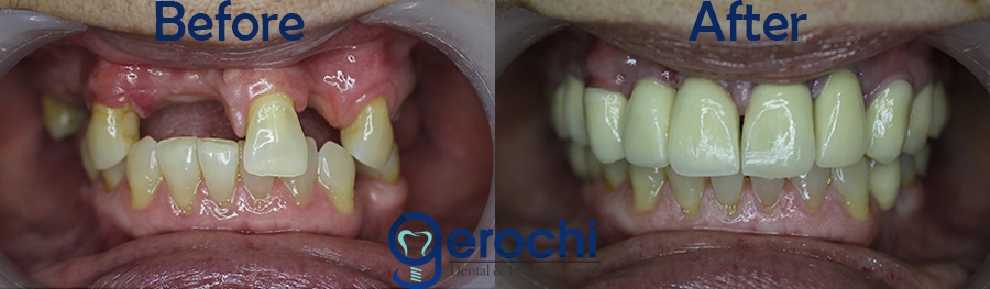 Before and After Restoration Implant