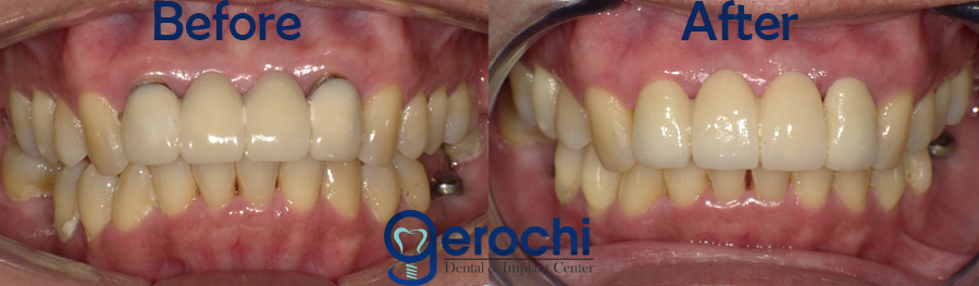 Before and After Zirconia Bridge