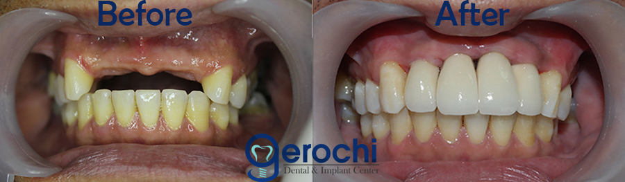 Before and After Zirconia Implant
