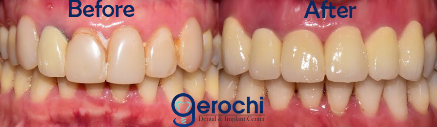 Dental Crown Philippines