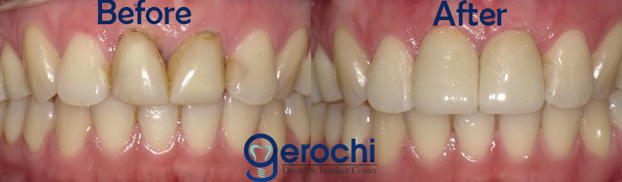 Dental Crown Makati
