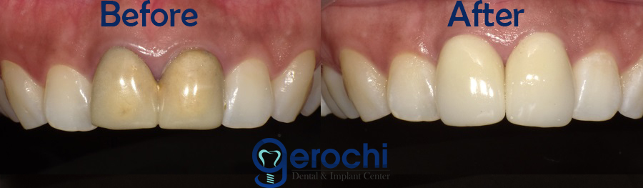 Dental Crown Veneers