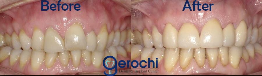 Dental Crown BGC